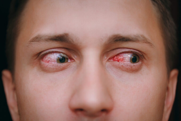Close,Up,Of,Two,Annoyed,Red,Blood,Eyes,Of,Male